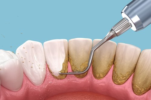 Scale and Clean in Merrylands - Beautiful Smile Dental Surgery