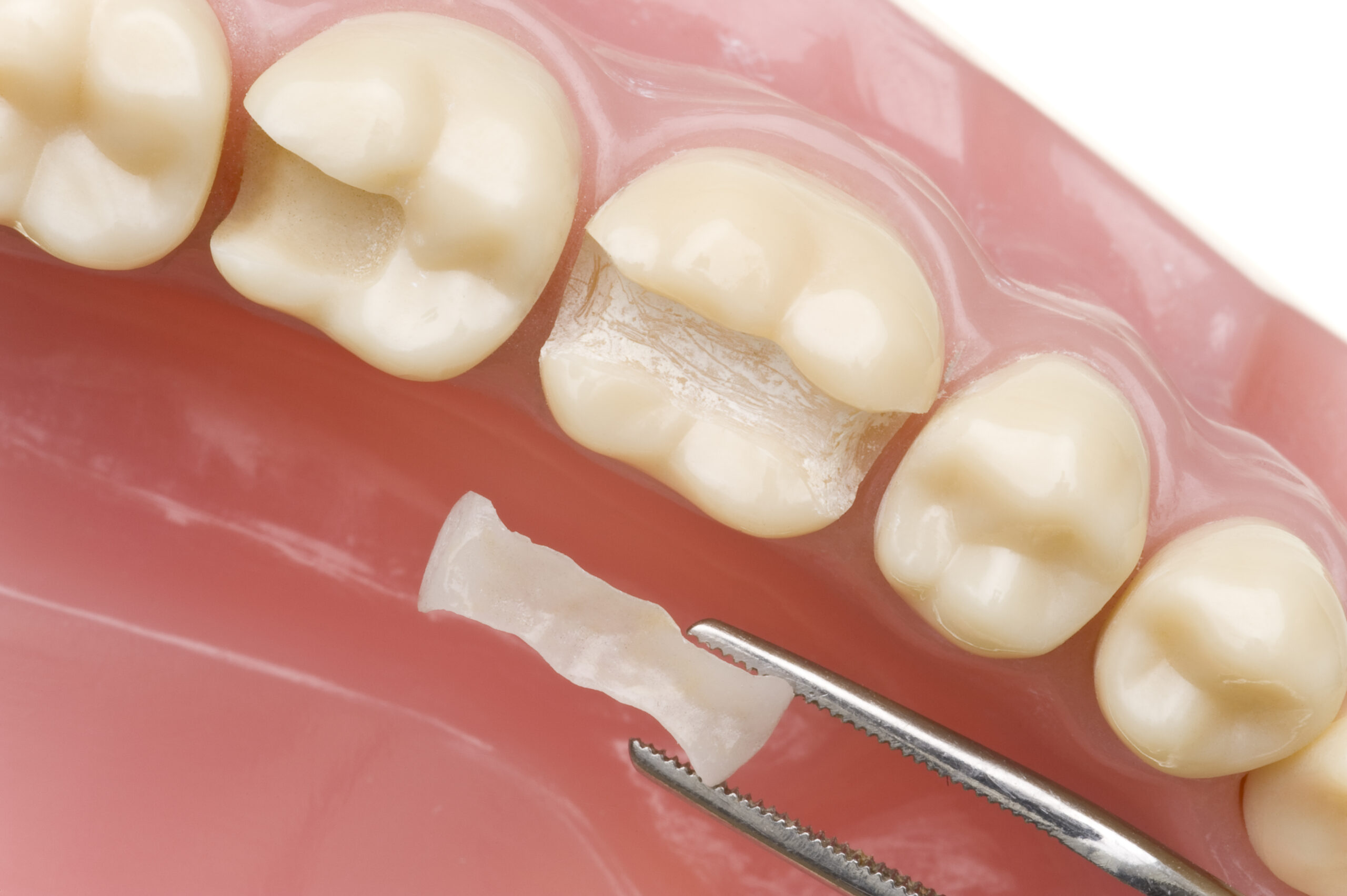 Beautiful Smile Dental Surgery Fillings - Cleaning Filling Polishing<br />
Restorative dental care by Beautiful Smile Dental Surgery in Merrylands.