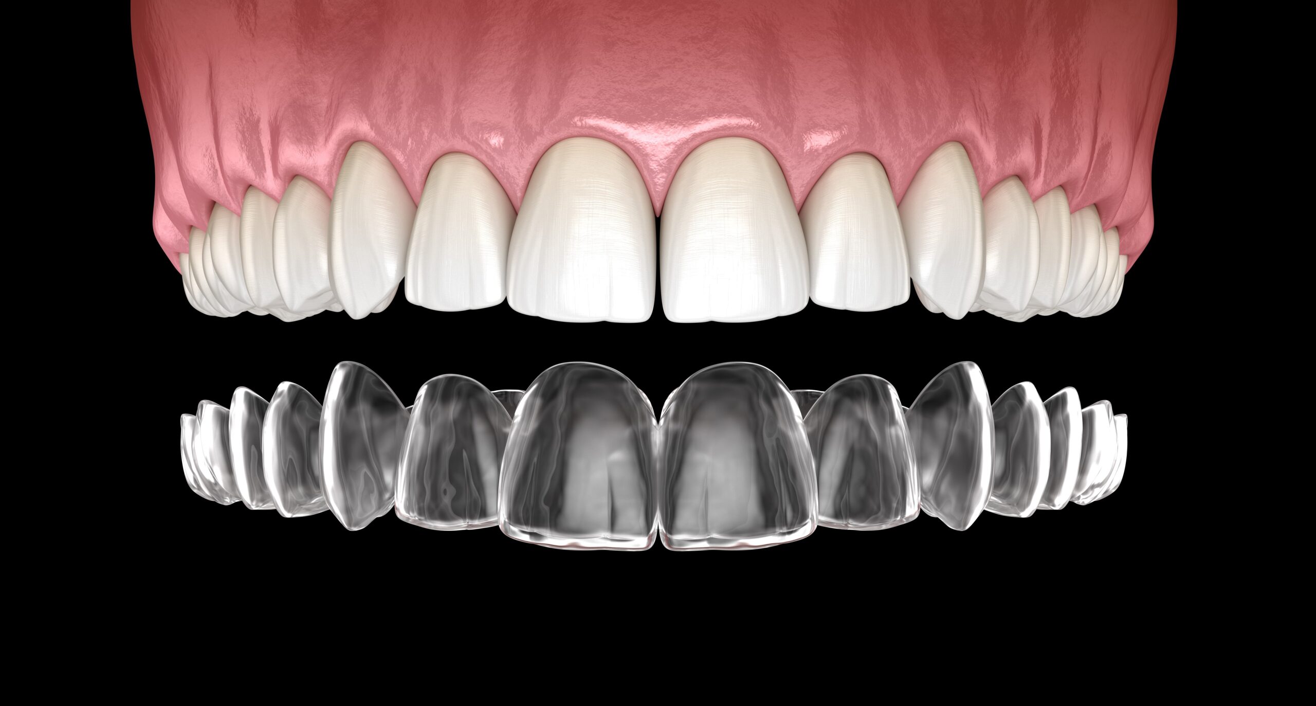 Crown and bridge treatments at beautiful smile dental surgery in Merrylands