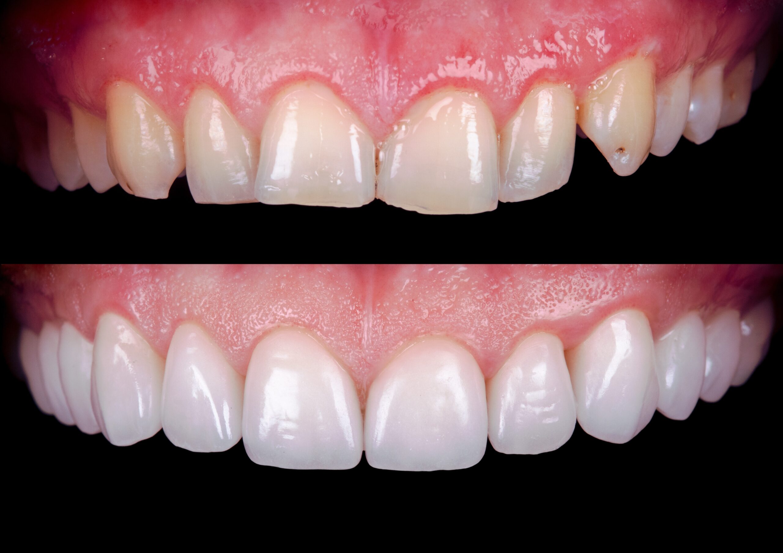 Cosmetic dental services at Beautiful Smile Dental Surgery in  Merrylands including Dental Veneers