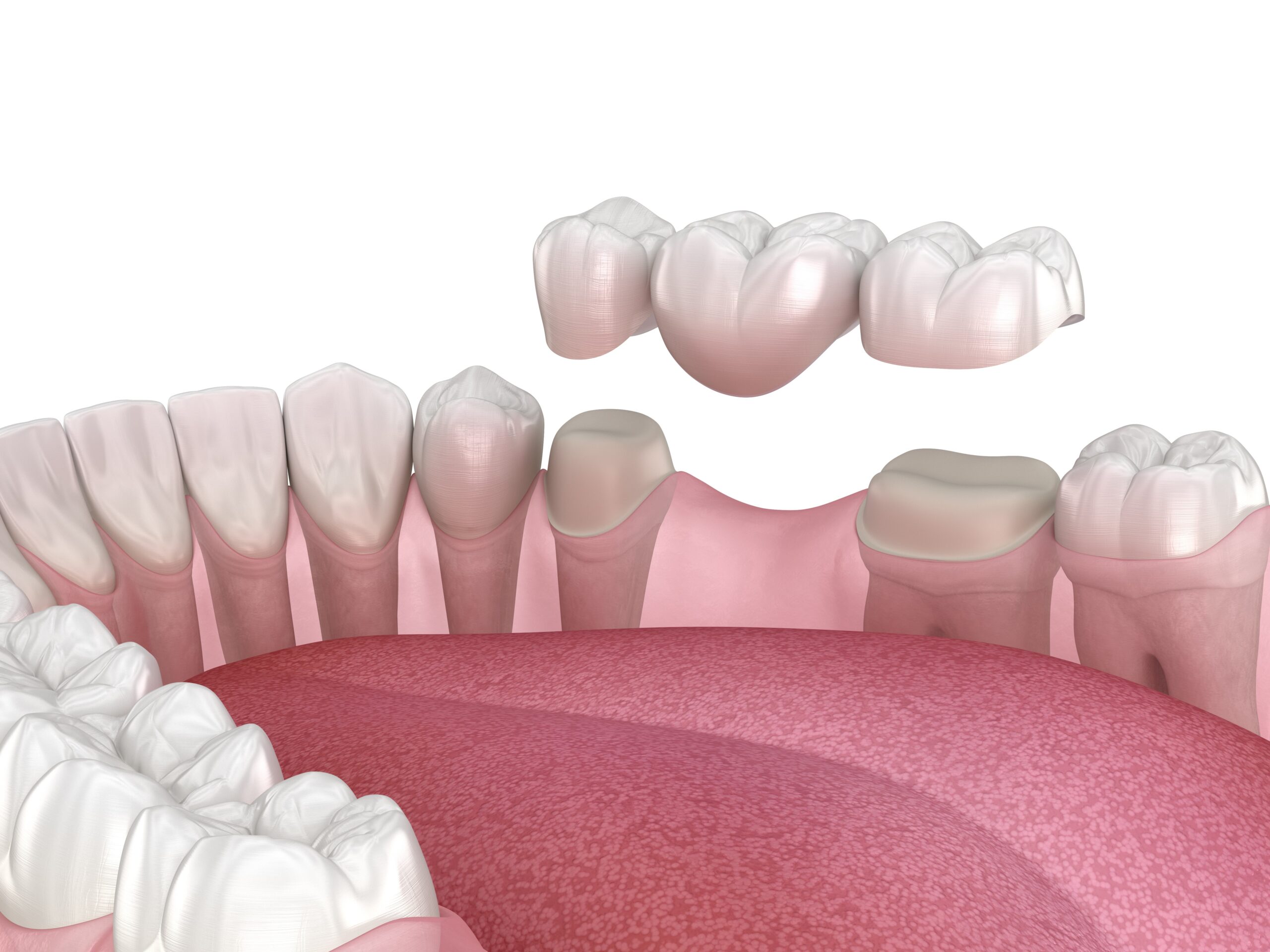 Crown and bridge treatments at beautiful smile dental surgery in Merrylands